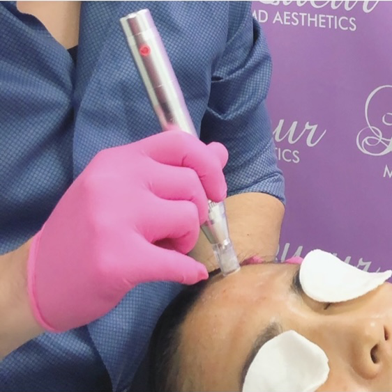 Radiofrequency Rf Microneedling Lueur Md